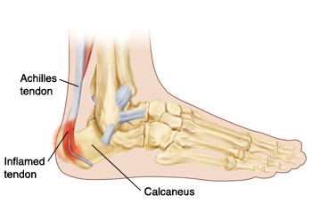 back of heel pain after running